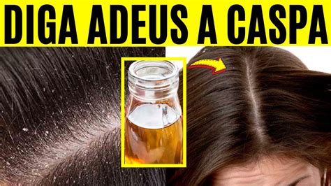 Vinagre De Maça Caspa - 3 Formas de Como Acabar com a Caspa Rápido com Vinagre de Maçã - YouTube