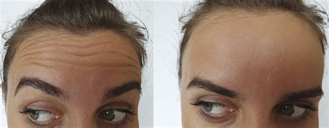 Botox Cheshire Anti Wrinkle Injections Cheshire Clinic