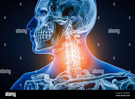 Halswirbels Ule Mit Arthrose Entz Ndung Oder Verletzung D Darstellung