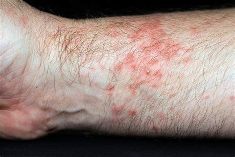 Systemic Corticosteroids for Urticaria: How Safe? How Effective ...