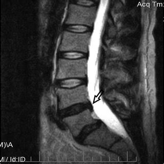 Axial MRI demonstrates minor thecal sac compression and left ...