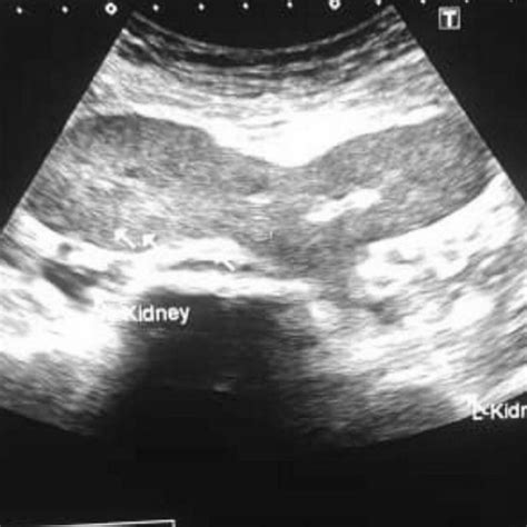 Abdominopelvic Ultrasound Scan Showed Ectopic Kidneys At The