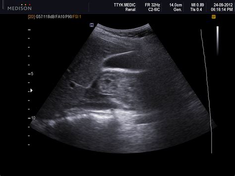 Vietnamese Medic Ultrasound Case 141 Rupture Of Duodenum Dr Phan