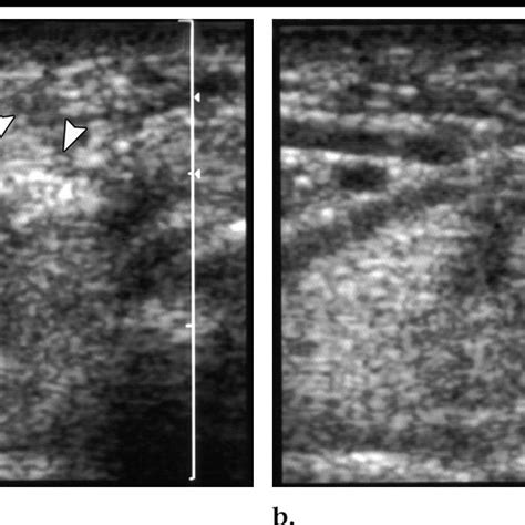 A Transverse Sonogram Of Median Nerve Arrow At Tunnel Inlet Download Scientific Diagram