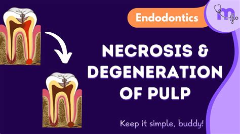 Pulp Degeneration And Necrosis Types Management Endodontics