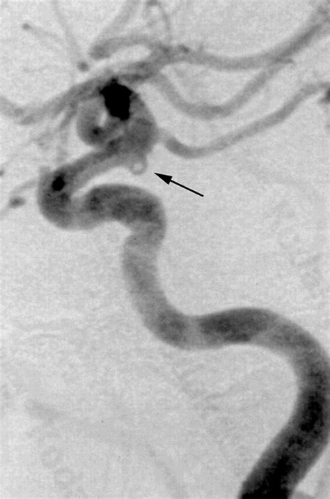 Dimpled Appearance Of A Posterior Communicating Artery Saccule An Angiographic Indicator Of