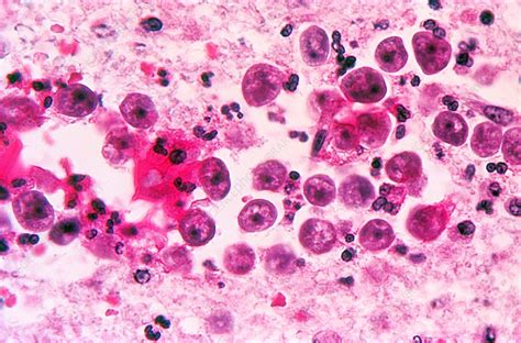 Naegleria Fowleri Amoeba Infection Light Micrograph Stock Image C0375988 Science Photo