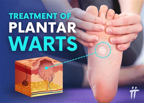 Plantar Warts: Treatments & Removal - Turan&Turan