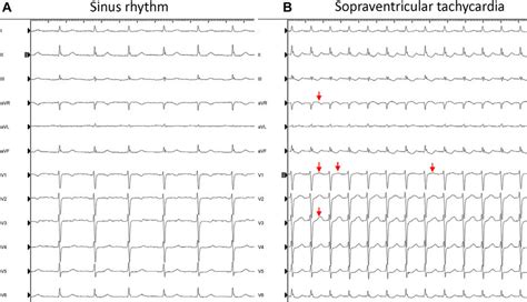 A 12 Lead Electrocardiogram During Sinus Rhythm And Supraventricular