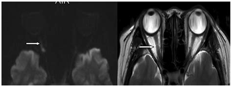 Diffusion Tensor Imaging Of Occult Injury Of Optic Radiation Following Optic Neuritis In