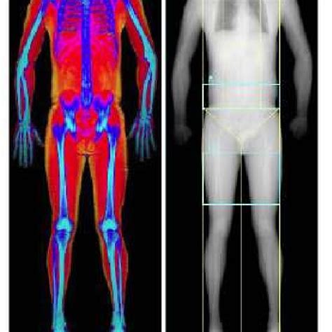 Image Obtained By Dxa To Measure Of Body Composition Download Scientific Diagram