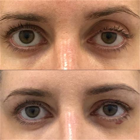 Ptosis Repair Before And After Photos Flora Levin Md