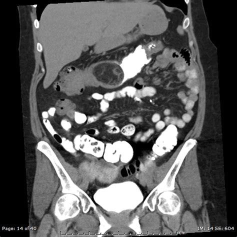 Colonic Intussusception Colonic Lipoma Image