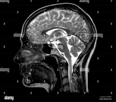 Human head and brain. Magnetic resonance imaging (MRI) scan of a ...