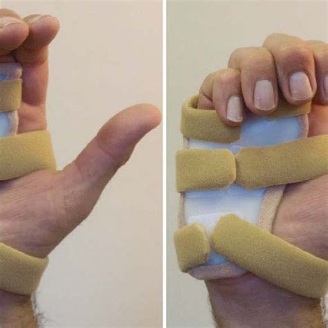 Trigger Intrinsic Stretch Splint A Volar Hand Based Splint