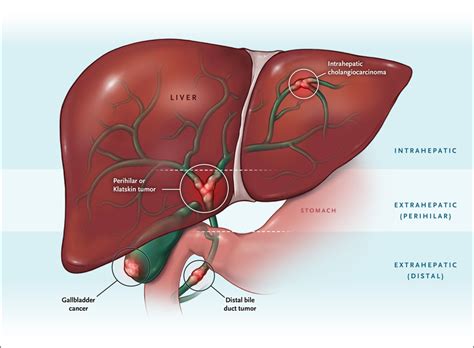 Case 8 2021 A 34 Year Old Woman With Cholangiocarcinoma Nejm