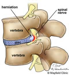 Is Your Lower Back Pain Caused by a Herniated Disc? - Virginia Spine ...