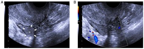 Transvaginal Ultrasonography Of Right Ovary A Gray Scale Ultrasound