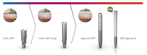 Neoarch Immediate Fixed Full Arch Solution Neodent Dental Implant Systems