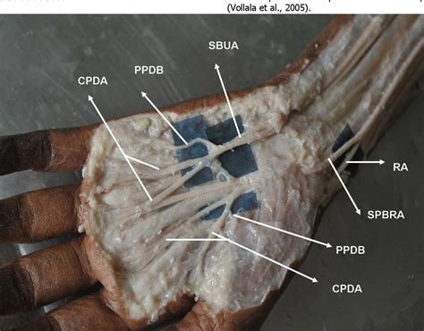 Figure 1 From AN ANATOMICAL VARIATION OF SUPERFICIAL PALMAR ARCH AND