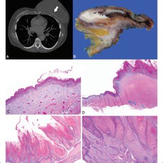 Computed Tomography Ct Macroscopic And Microscopic Features Of Case