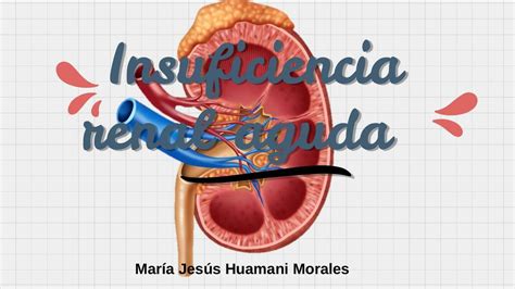 Insuficiencia Renal Maria Jesus Huamani Morales Udocz