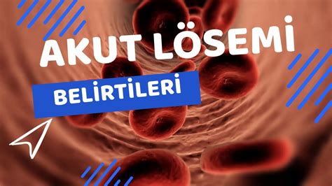 Akut Lösemi Belirtileri Nelerdir Akut Löseminin 5 Belirtisi YouTube