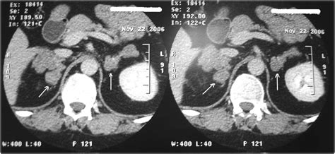 Diagnosis And Treatment Of Adrenocorticotrophic Hormone Independent Macronodular Adrenocortical