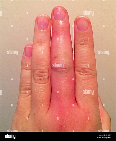 Swollen Finger Hi Res Stock Photography And Images Alamy