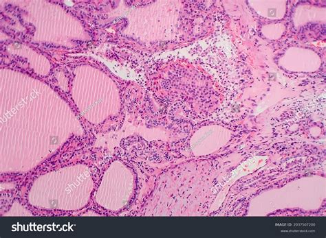 Endemic Goiter Light Micrograph Abnormal Enlargement Stock Photo