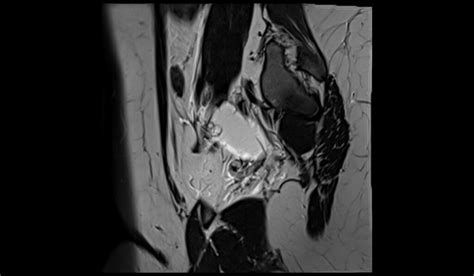 ovarian cancer protocol sagittal t2 images - mrimaster