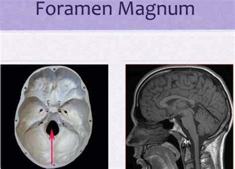 Clin Med Ii Neuro Approach To The Neuro Patient Flashcards Quizlet