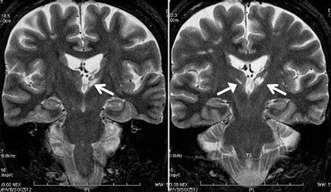 Figure 1 From Vascular Dementia By Thalamic Strategic Infarct