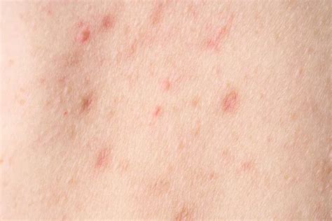 Skin With Acne With Red Spots Health Problem Skin Diseases Close Up