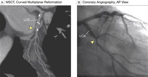 Noninvasive Coronary Angiography With Multislice Computed Tomography