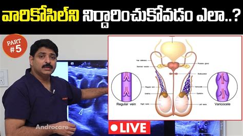 వరకసల నరదరణ How to Diagnose Varicocele Dr Rahul Reddy