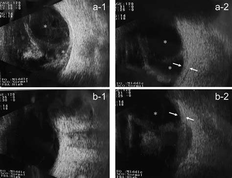 B Scan Echographic Image Of The Eyes Of A Patient With Posterior