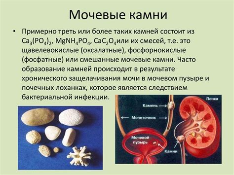 Мочевые камни: причины, симптомы и лечение мочевых камней