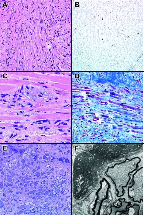 Histopathology A Photomicrograph Showing Interweaving Fascicles Of