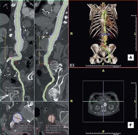 Abdominal Aortic Aneurysms Thoracic Key