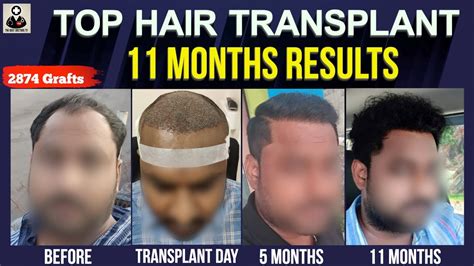 11 Months Hair Transplant Results Timeline Month By Month Progress