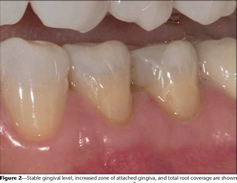 Table From Restorative And Periodontal Considerations For The