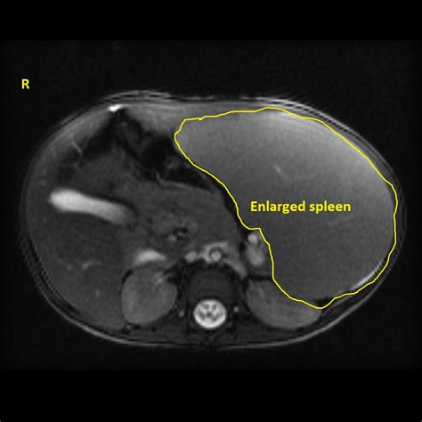 Cirrhosis Mri Wikidoc