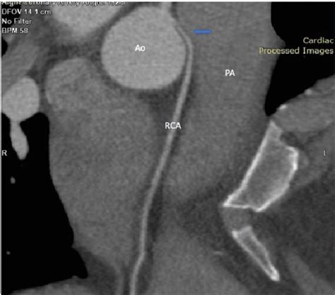 Figure 1 From Surgical Repair Of Anomalous Aortic Origin Of Coronary