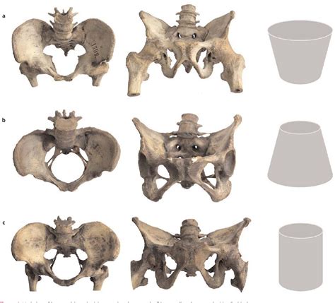 Figure 1 From Relationship Between The Shape Of The Obturator Foramen