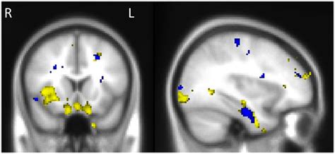 Voxel Based Morphometry Results Showing Regions That Correlate With