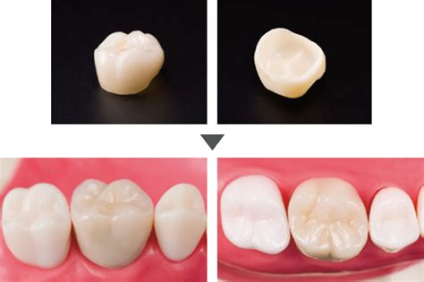クラウン・奥歯（被せ物） 土浦・つくばの歯医者なら天川歯科