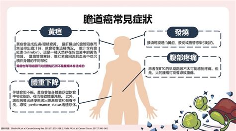 「隱藏版癌王」膽道癌難發現 留意9大風險因子、4大症狀 康健雜誌