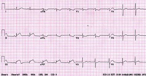 Subendocardial Infarction Ecg