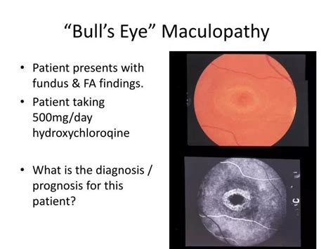 PPT - “Bull’s Eye” Maculopathy PowerPoint Presentation, free download ...